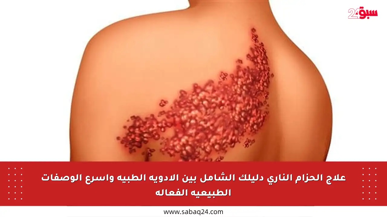 علاج الحزام الناري دليلك الشامل بين الأدوية الطبية وأسرع الوصفات الطبيعية الفعالة
